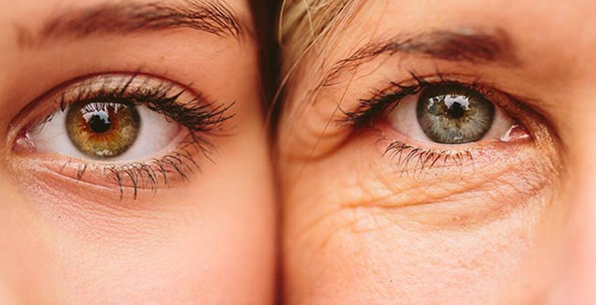 العلامات الخارجية لشيخوخة الجلد حول العينين لدى امرأتين من أعمار مختلفة
