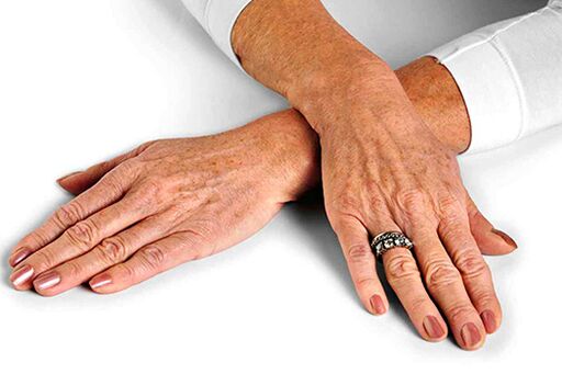 جلد اليدين مع التغيرات المرتبطة بالعمر والتي تتطلب استخدام تقنيات تجديد